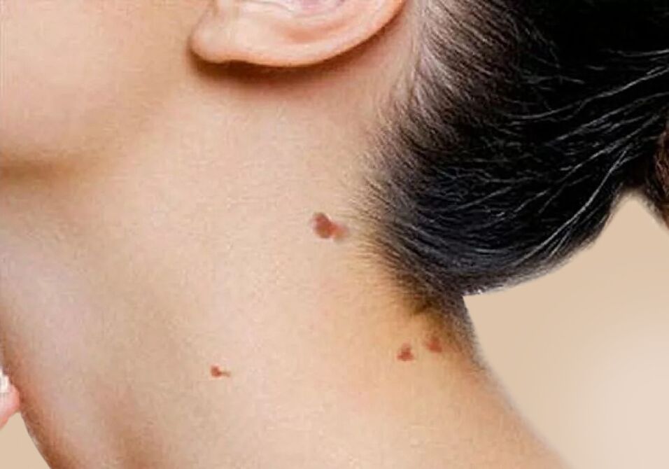 Het verschijnen van papillomen in de nek na activering van HPV in het lichaam