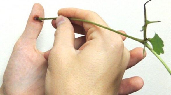 Cauterisatie van papilloma op de vinger met stinkende gouwe sap