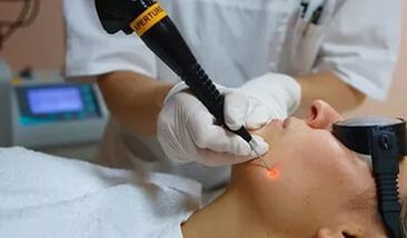 Een effectieve procedure voor het verwijderen van papilloma op het gezicht met een laser