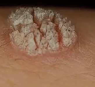 Eenvoudige papilloma's