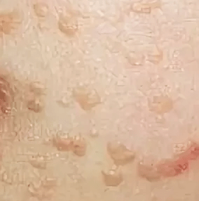 Platte papilloma's