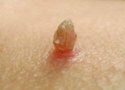Scherp papilloma