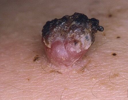 Zwart papilloma