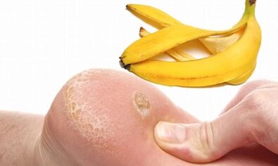 Bananenschil voor de behandeling van een plantaire wrat