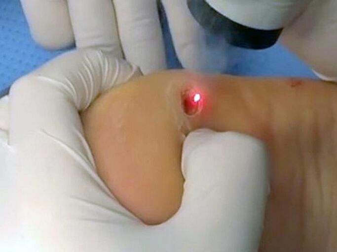 laserbehandeling voor wratten
