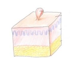 hoe zich te ontdoen van papilloma op het lichaam