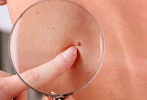 redenen voor het verschijnen van papillomen op het menselijk lichaam