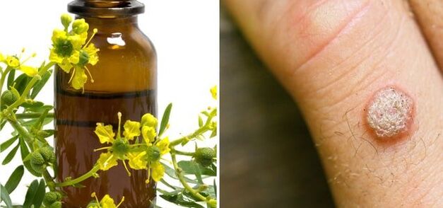 behandeling van wratten met farmaceutische stinkende gouwe