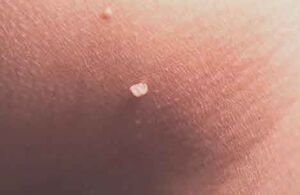 Papilloma op de huid
